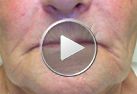 Практически полное восстановление верхней губы с подчеркиванием контура середины губы, реконструкция суб носовых хребтов линия которых отклоняется от губной складки (зеленая стрелка на рисунке )<BR/>Реконструкция нижней  губы