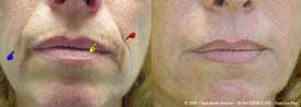 Clearing the skin breakage due to nasolabial folds, the labial commissures, and solar pleated.