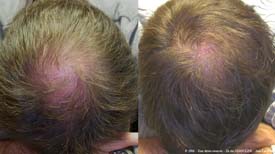 Улучшение плотности и  толщины волос после 12 сеансов мезотерапии кожи головы, связанных со специфическим леченем