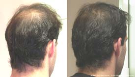 Улучшение плотности и  толщины волос после 12 сеансов мезотерапии кожи головы, связанных со специфическим леченем