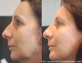 Cheekbone, jowl and temporal area lift. Correction of nasal profile.