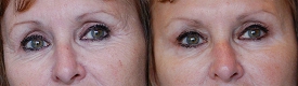 Устранение гусиных лапок ботоксом, легкое поднятие бровей для зрительного увеличения глаз 