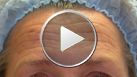 Annual correction of forehead wrinkles. Eyebrow lift