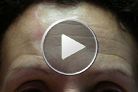 Correction of the forehead asymmetry