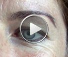 Reduction of the upper eyelid ptosis with Botox®