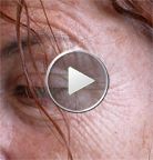 Déplissage du contour de l'œil par Botox seul en 5 jours 