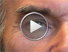 Better shape of the eye contours with a light eyebrow lift due to Botox®