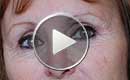 Traitement des rides de la patte d'oie, avec botox seul, et rafraichissement du regard par lègère ascension des sourcils