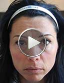 Correction des rides d'expression grâce à une seule injection de Botox. Effet liftant sur les paupières et les sourcils avec look 