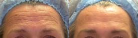 Annual correction of forehead wrinkles. Eyebrow lift