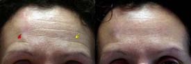 Correction of the forehead asymmetry