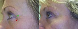 Correction of the crow's feet wrinkles and a light raising of the eyelid which enlarges the look.