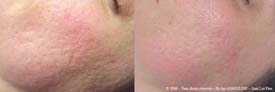 Bonne atténuation de cicatrices d'acné. Résultat au bout de 4 séances de peeling au TCA (une séance tous les 15 jours)