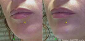 Aesthetic correction of mild retrognathia