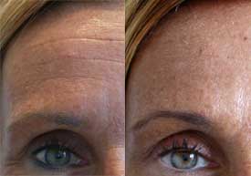 Correction des rides du front et de la patte d'oie par Botox®. Peau tannée par le soleil