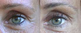 Correction of the crow's feet wrinkles with Botox®. A skin tanned by the sun