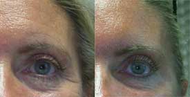 Correction of the crow's feet wrinkles with Botox®. A skin tanned by the sun