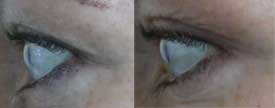 Reduction of the upper eyelid ptosis with Botox®