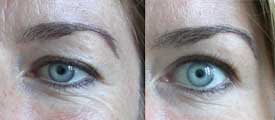 Reduction of the upper eyelid ptosis with Botox®