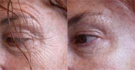 Déplissage du contour de l'œil par Botox seul en 5 jours 