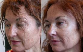 Eye contour lift with Botox® and reduction of facial wrinkles with hyaluronic acid and mesolift