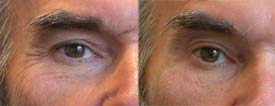 Better shape of the eye contours with a light eyebrow lift due to Botox®