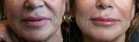 Revitalization around the mouth with Hyaluronic Acid