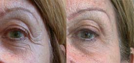 Raising of the outer portion of the upper eyelid and brow, allowing to clear the crow's feet wrinkles with Botox®