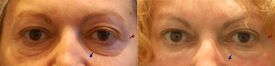 Correction of dark circles, tear trough and bags under the eyes