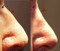 Correction of nasal profile without surgery