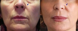 Improvement of fine wrinkles but also dark circles by mesolift and hyaluronic acid Surgiderm®