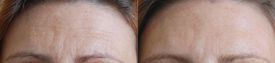 Treatment of forehead wrinkles with Botox®