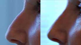 Rectification du profil nasal