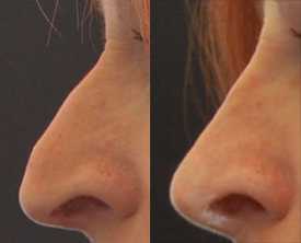 Correction of nasal profile