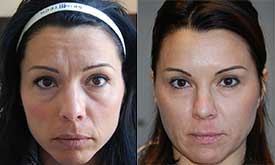 Correction des rides d'expression grâce à une seule injection de Botox. Effet liftant sur les paupières et les sourcils avec look 